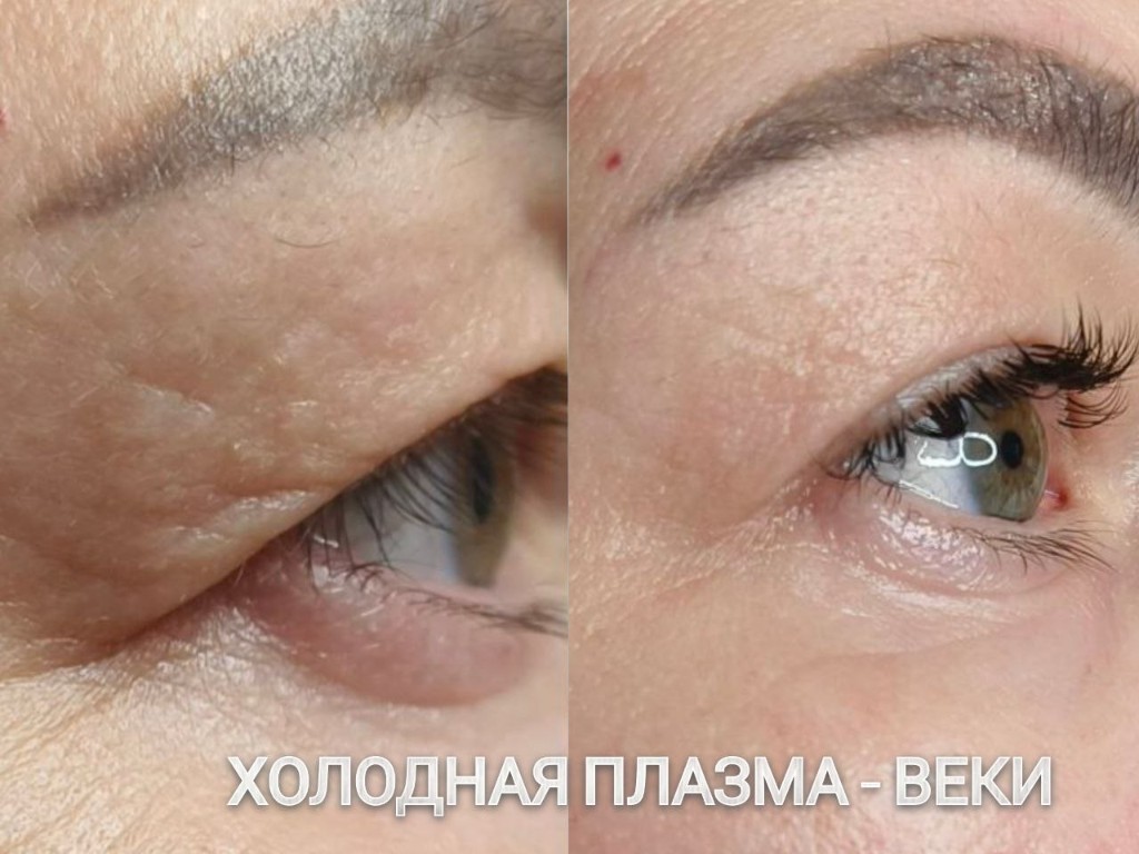 Эстетическая косметология, работа 1 — холодная плазма, веки