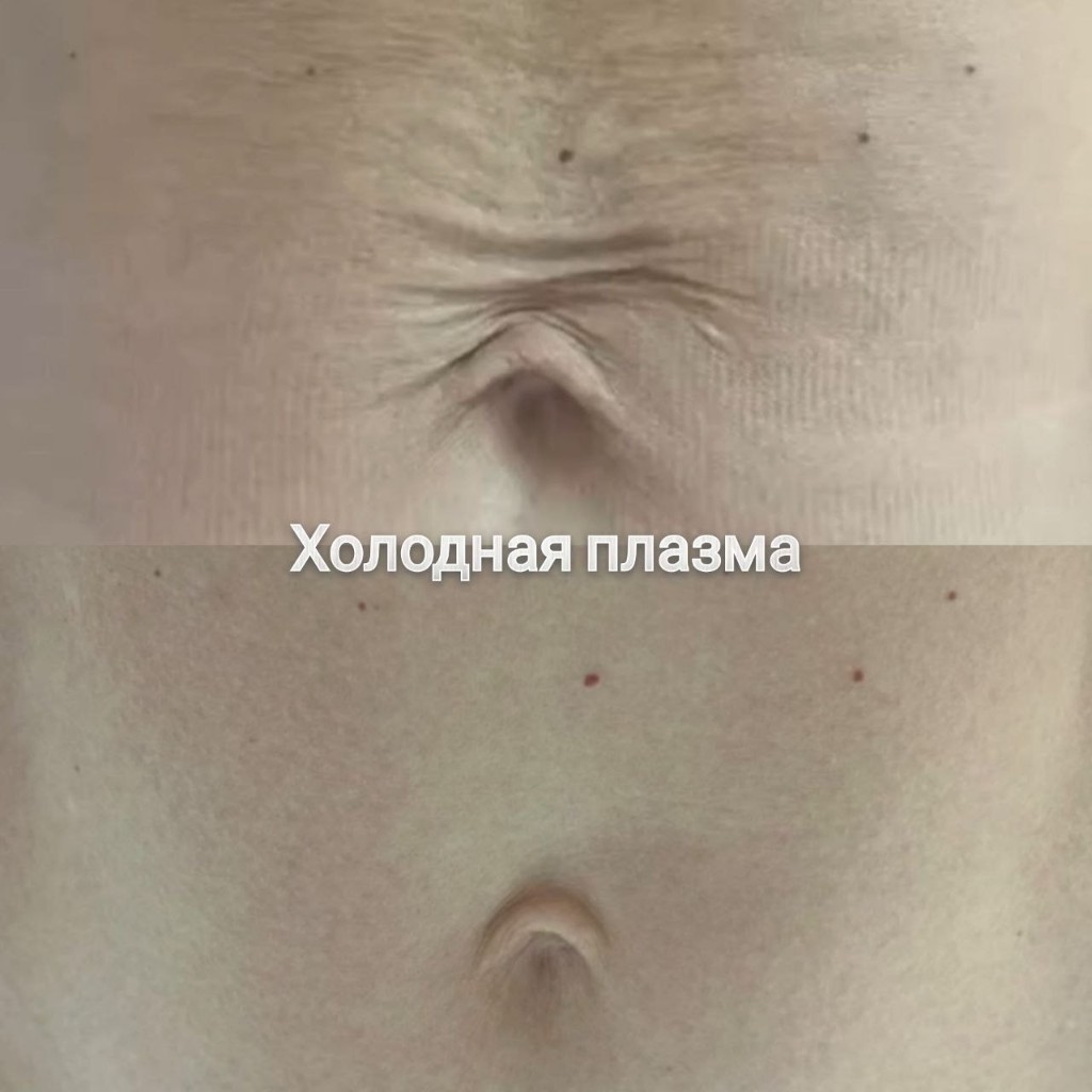Эстетическая косметология, работа 5 — холодная плазма