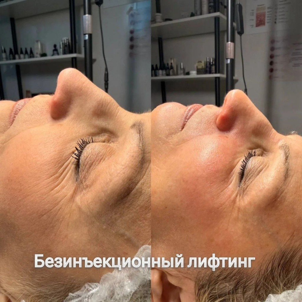 Эстетическая косметология, работа 6 — безинъекционный лифтинг