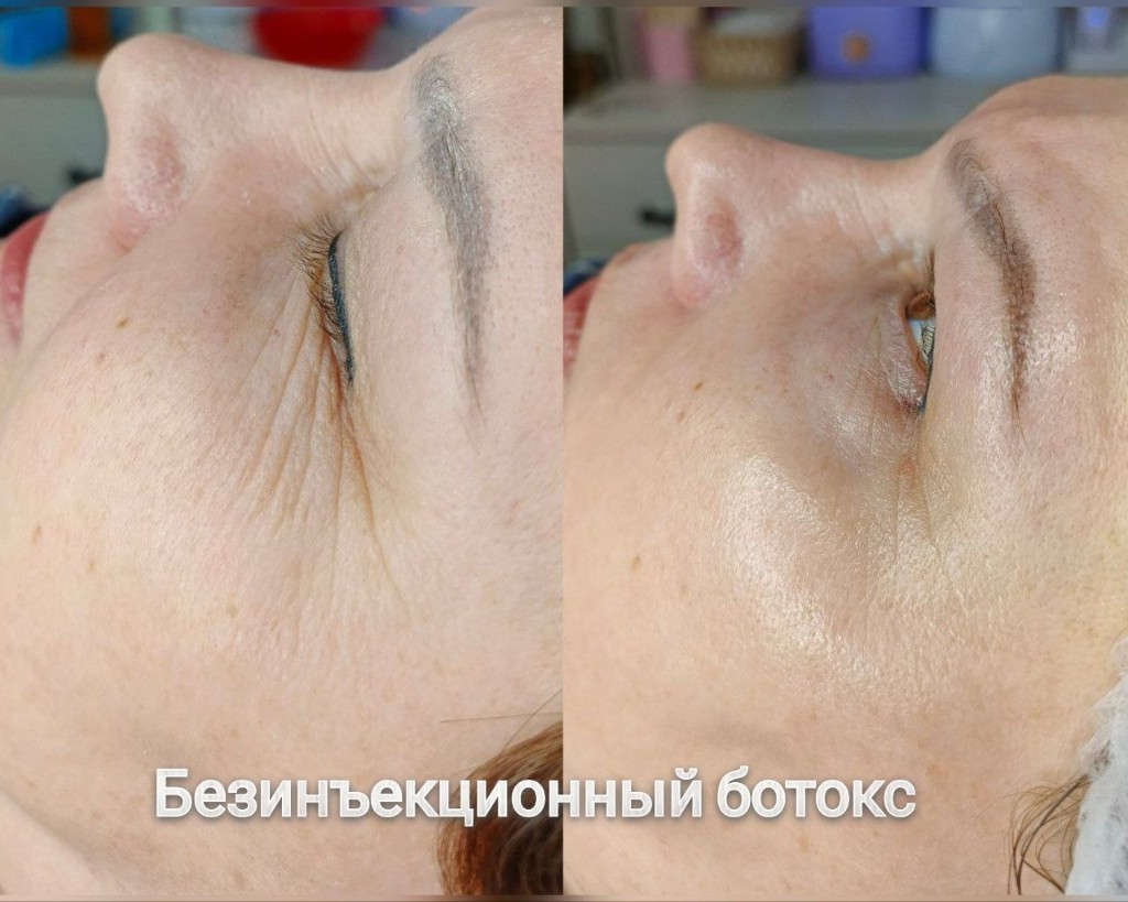 Эстетическая косметология, работа 8 — безинъекционный ботокс