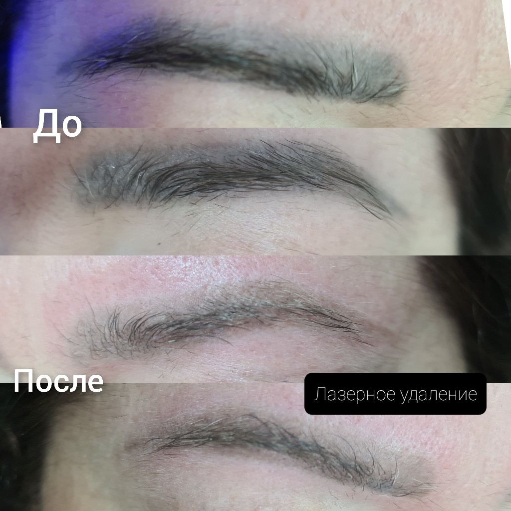 Удаление татуажа бровей, работа 3